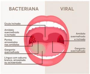 Inflamação da garganta comum em infecções respiratórias, destacando a importância de tratamento e diagnóstico adequados.